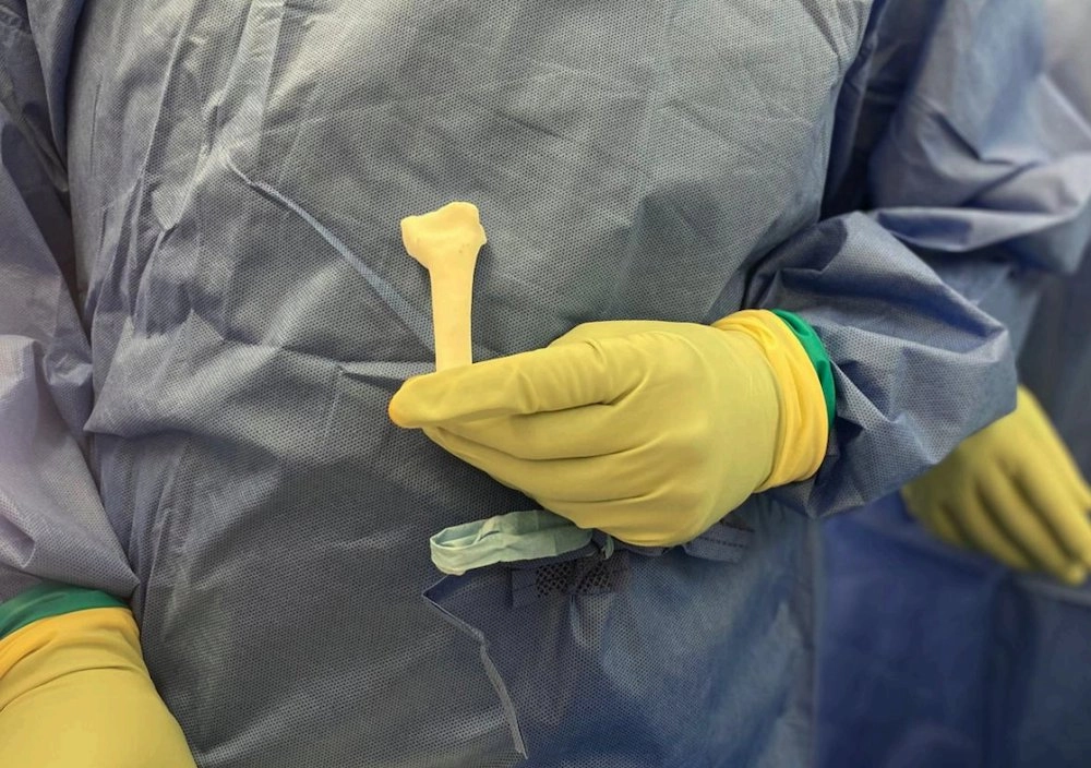 Warwickshire NHS Trust Achieves Milestone with First 3D Printed Wrist Implant Surgery