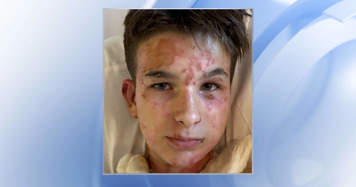 Local Boy Overcomes 3D Printer Accident: A Journey of Recovery from Severe Burns