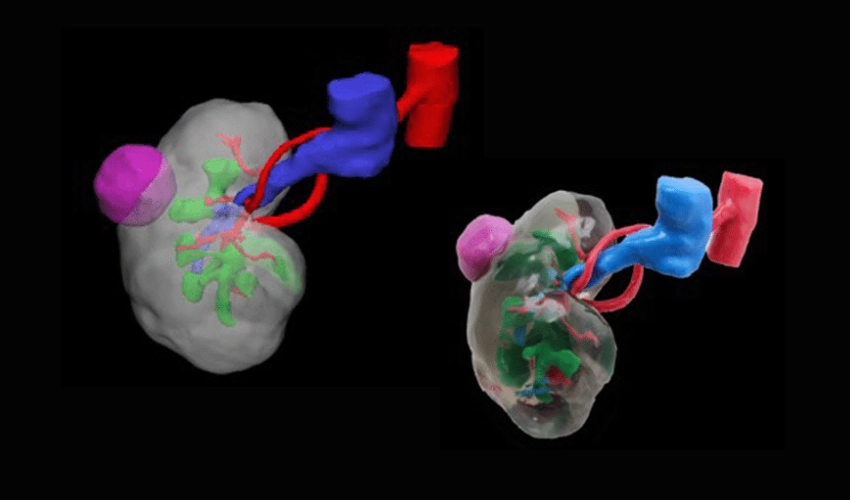 Revolutionizing Renal Cancer Research: The Impact of 3D Printed Kidney Tumors