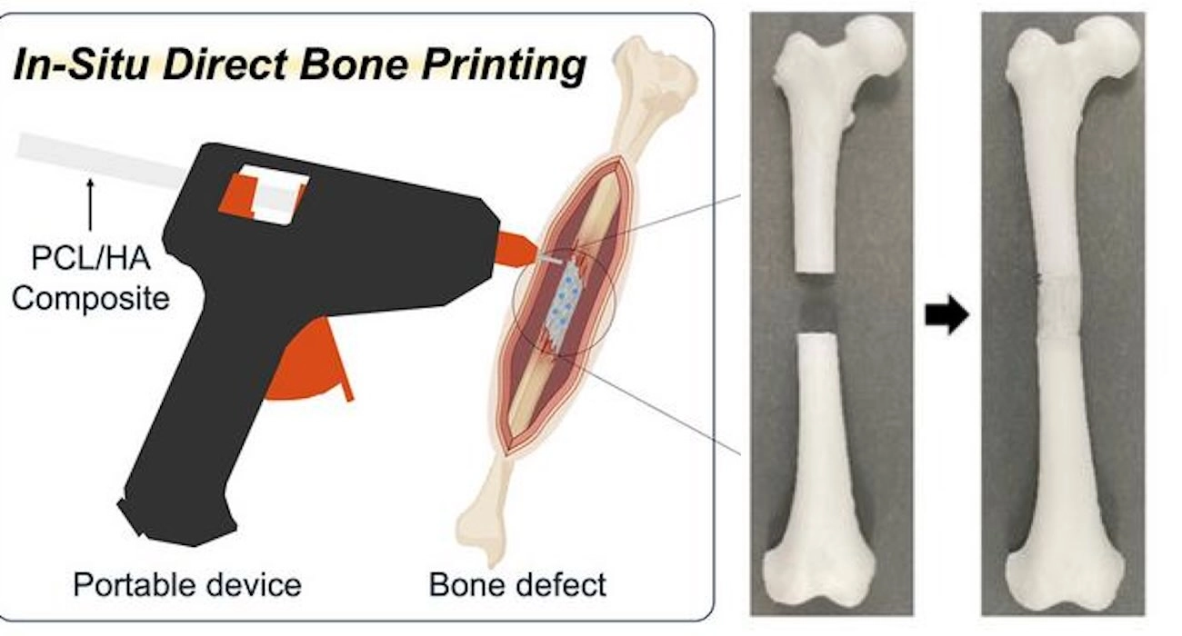 Revolutionizing Surgery: The 3D-Printing ‘Glue Gun’ for Bone Fracture Repair